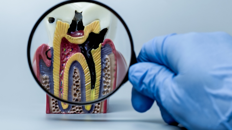 Răng sâu vào tủy là gì? Đây là giai đoạn sâu răng đã tiến triển nặng