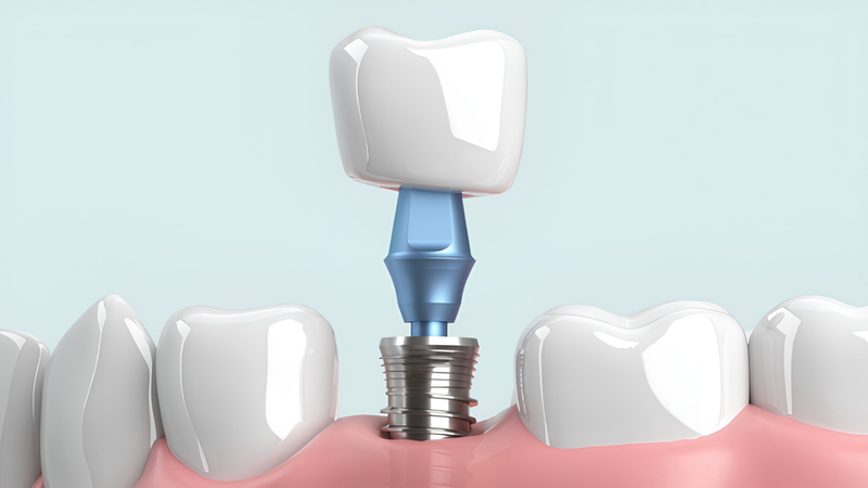 Cấy ghép Implant giúp thay thế răng mất và phục hồi ăn nhai hiệu quả