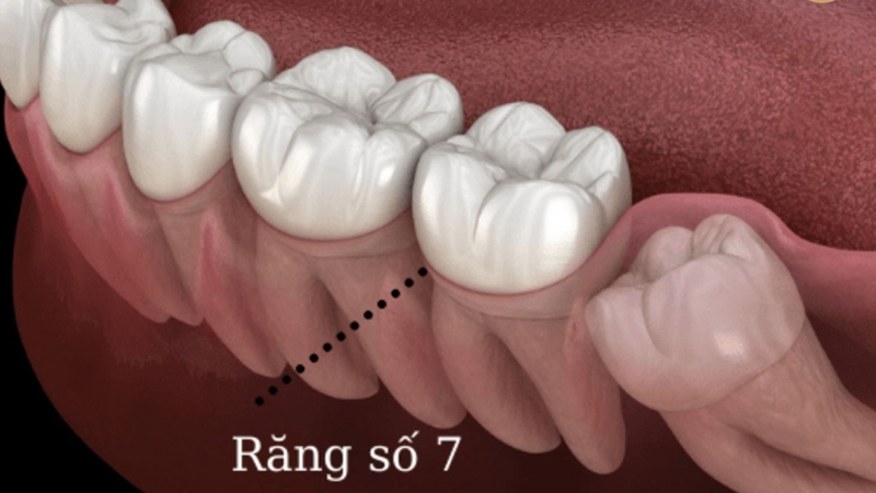 rang-so-7-bi-sau-co-nen-nho-khong-va-cach-cham-soc-rang-mieng-ngua-sau-rang 1.jpg