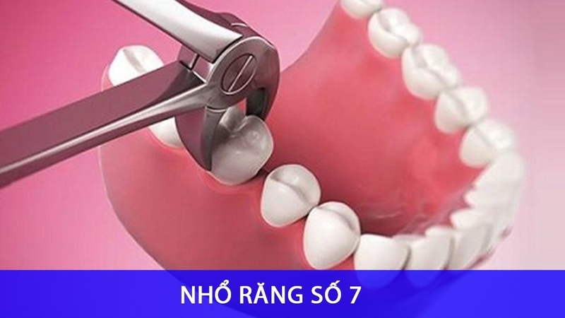 rang-so-7-bi-sau-co-nen-nho-khong-va-cach-cham-soc-rang-mieng-ngua-sau-rang 3.jpg