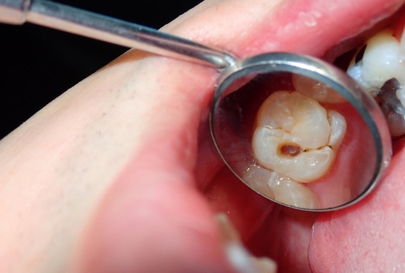 Răng số 7 bị sâu thường được chỉ định trám răng để khắc phục