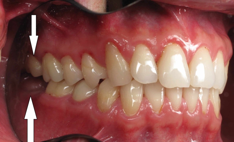 Nhổ răng số 7 chỉ áp dụng khi tổn thương quá nặng và không thể phục hồi