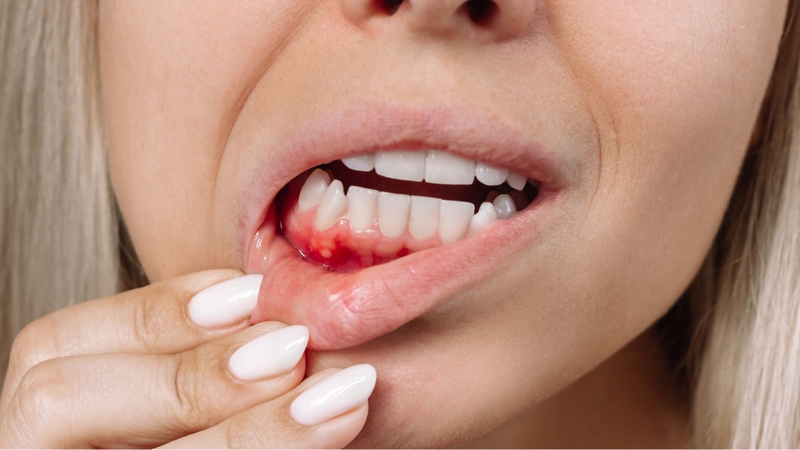 Răng sứ kim loại có thể gây kích ứng nướu ở một số cơ địa nhạy cảm, dẫn đến viêm lợi hoặc sưng đỏ