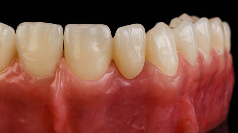 Zirconia Cercon được sử dụng trong nhiều dạng phục hình răng