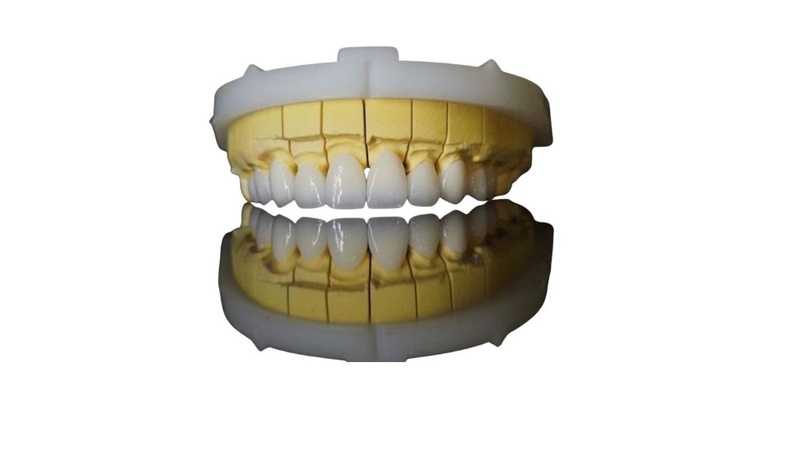 Răng sứ Cercon có màu sắc tự nhiên, đáp ứng nhu cầu thẩm mỹ