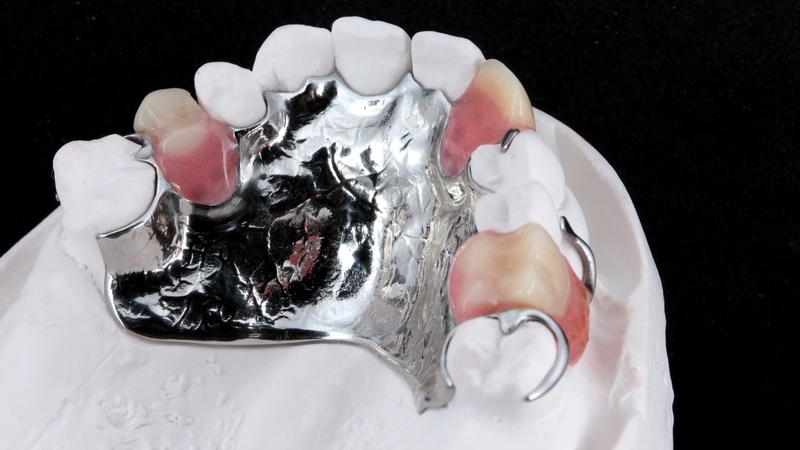 Răng sứ Chrome Cobalt là gì và có tốt không? 1