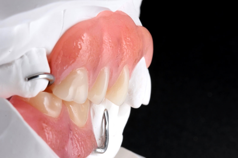 Răng sứ Chrome Cobalt là gì và có tốt không? 2