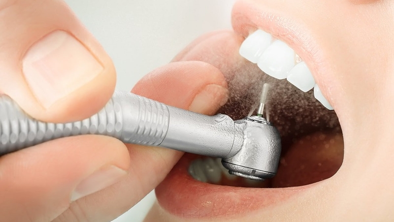 Răng sứ có mài được không? Trường hợp cần mài răng sứ 1