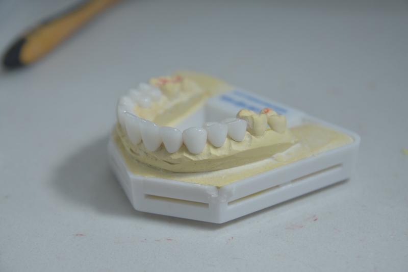 Răng sứ DDBio là gì? Có tốt không? Giá bao nhiêu 1