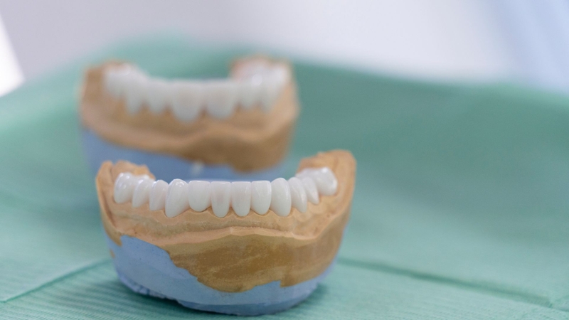 Răng sứ Katana có mấy loại? Ưu điểm của răng sứ Katana 1