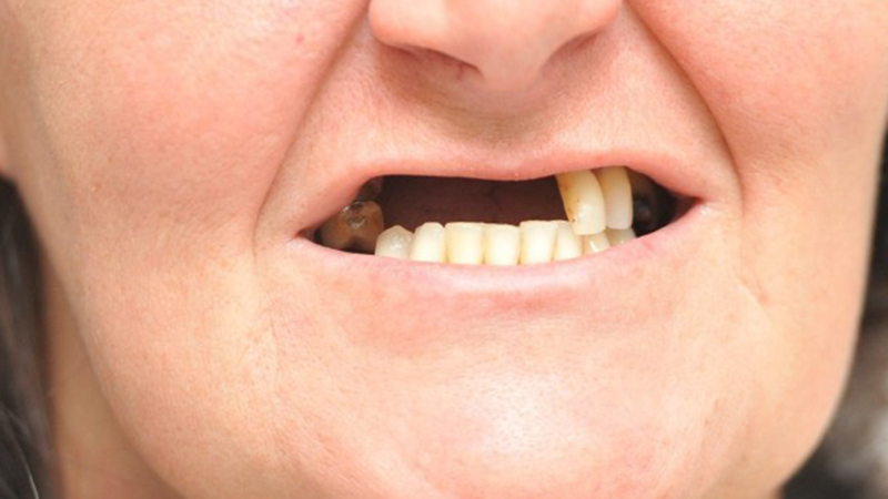 Người cao tuổi vẫn có thể làm răng sứ một cách an toàn