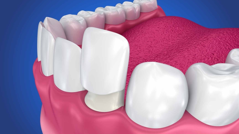 Răng sứ kim cương là gì? Ưu và nhược điểm của loại răng này 1