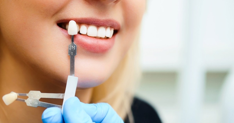Răng sứ kim cương là gì? Ưu và nhược điểm của loại răng này 4