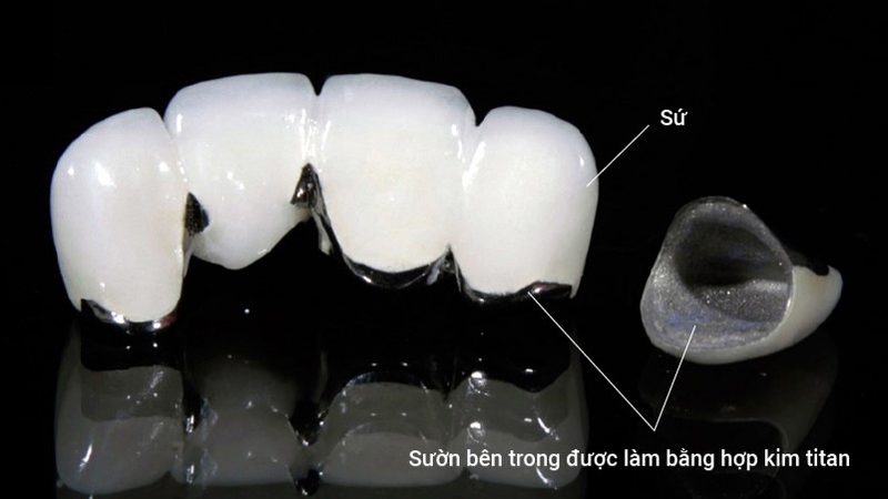 Răng sứ kim loại có mấy loại? Có nên sử dụng răng sứ kim loại không? 3