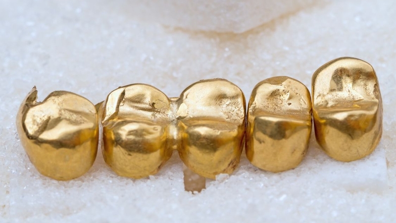 Răng sứ kim loại quý: Ưu điểm nổi bật và quy trình thực hiện 1