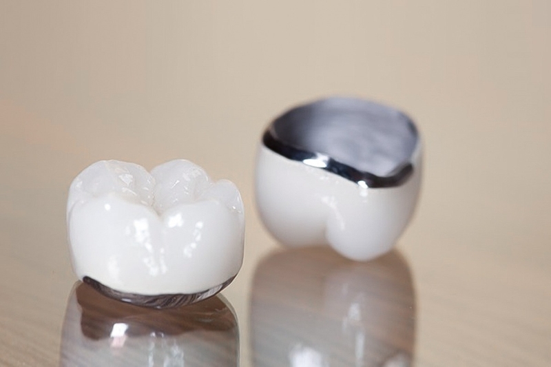 Răng sứ Mỹ là gì? Bọc răng sứ Mỹ có tốt không? 2