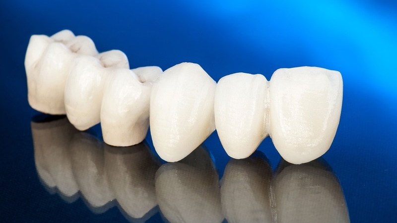 Răng sứ zirconia: Ưu nhược điểm và phân loại 2