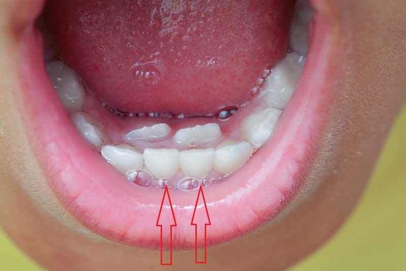 Răng sữa không rụng: Nguyên nhân và cách xử lý 1