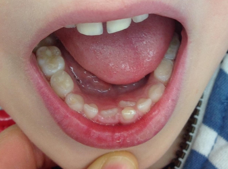 Răng sữa không rụng: Nguyên nhân và cách xử lý 2