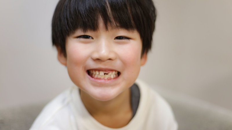 Răng sún là tình trạng tổn thương mô cứng của răng xảy ra do quá trình khử khoáng kéo dài