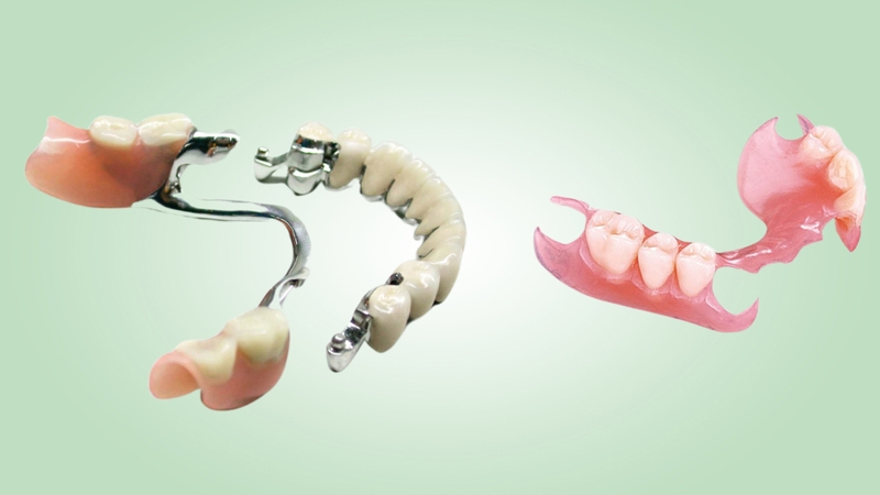 Răng tháo lắp Composite là gì và có ưu điểm gì? 0