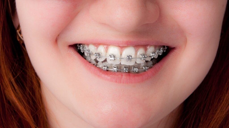 Răng vẩu là gì? Răng vẩu phải làm sao? 3