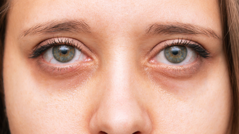 Sự khác biệt so với quầng thâm mắt