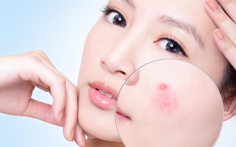 Rau diếp cá có trị được mụn nhọt không?2