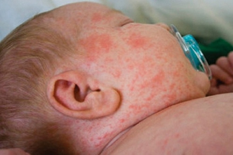 Rau ngổ chữa bệnh sởi - bài thuốc dân gian an toàn cho bé 2