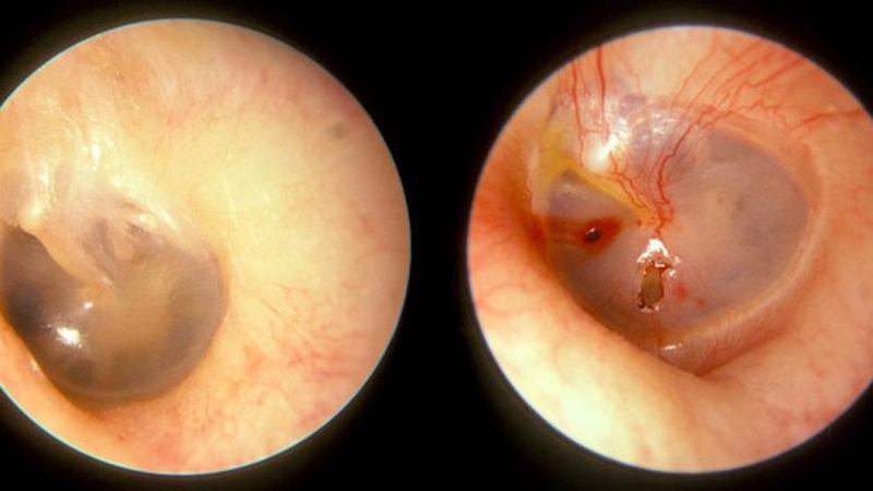 Ráy tai bị chảy máu có sao không? 1