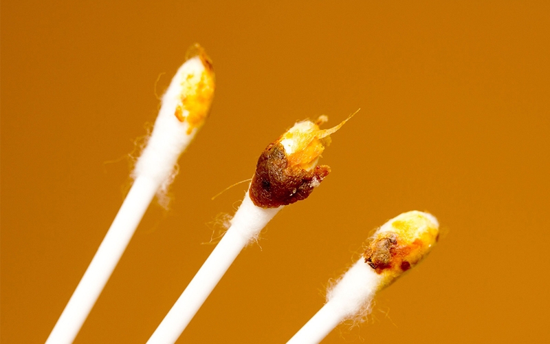 Ráy tai có màu đen có sao không? 1