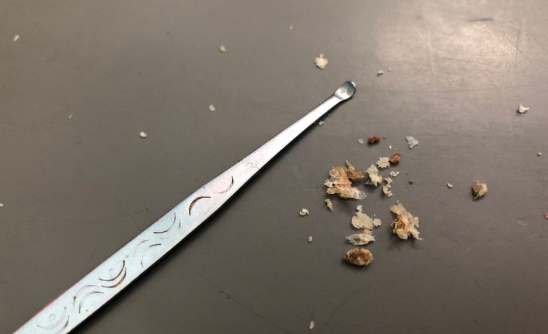 Ráy tai khô cứng cần xử lý thế nào 1