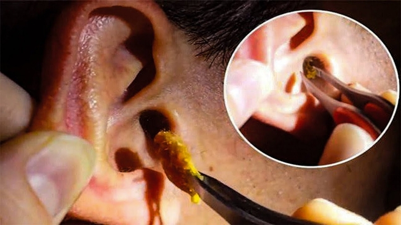 Ráy tai là gì, màu sắc ráy tai biểu thị bệnh lý gì? 2