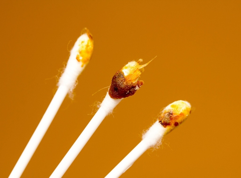 Ráy tai là gì, màu sắc ráy tai biểu thị bệnh lý gì? 3