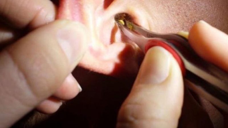 Ráy tai như thế nào là bình thường? Ráy tai ướt hay khô? 2