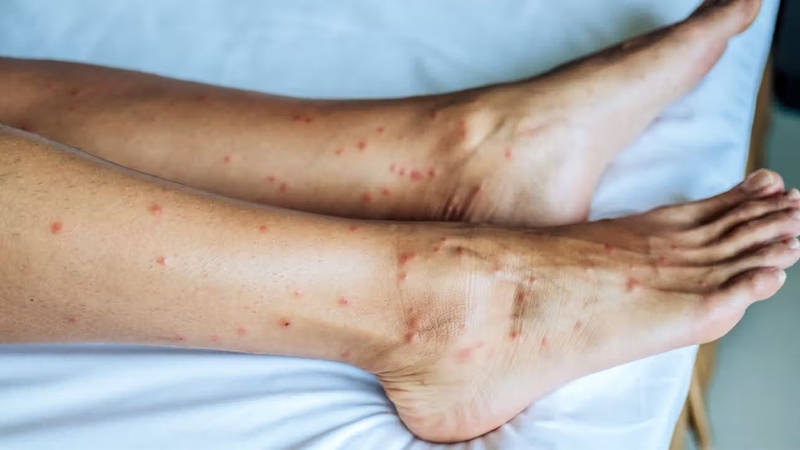 Gãi nhiều vào vết rệp cắn có thể làm da viêm và để lại thâm