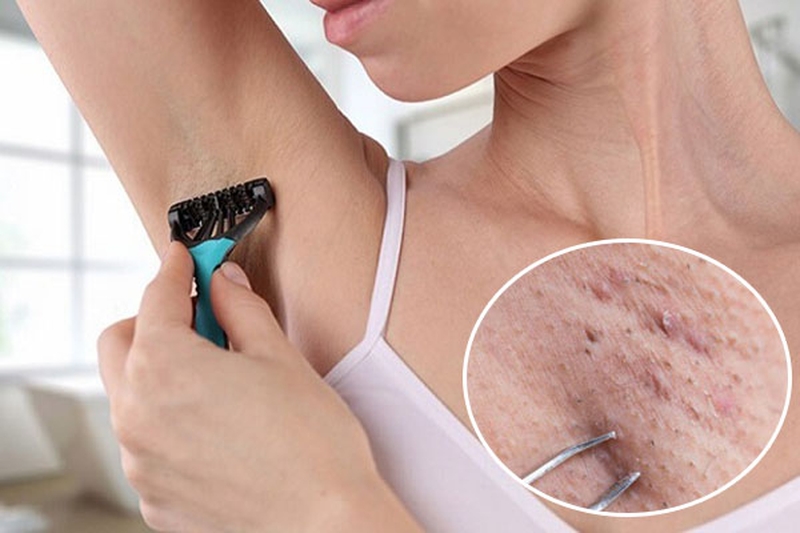 Sử dụng dao cạo hoặc nhíp để nhổ lông nách lâu ngày sẽ khiến cho lỗ chân lông bị giãn nở, lông sẽ mọc trở lại dày và cứng hơn