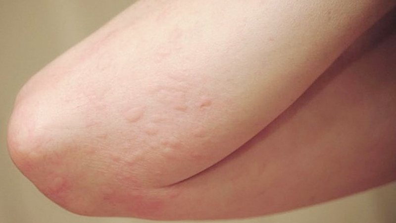 Mề đay là một trong những tác dụng phụ của thuốc Gentrisone