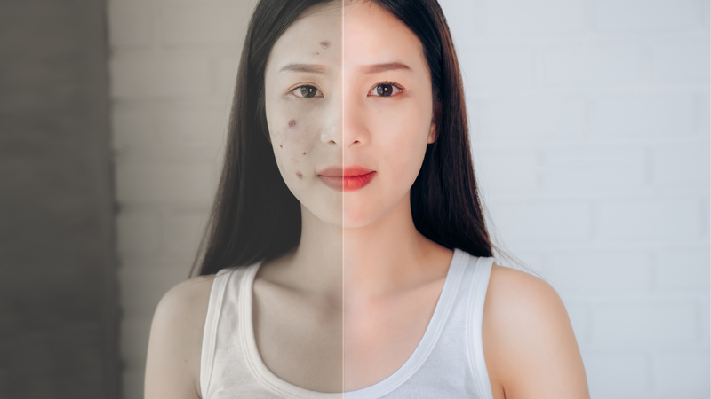 Công thức làm sạch an toàn cho da mụn