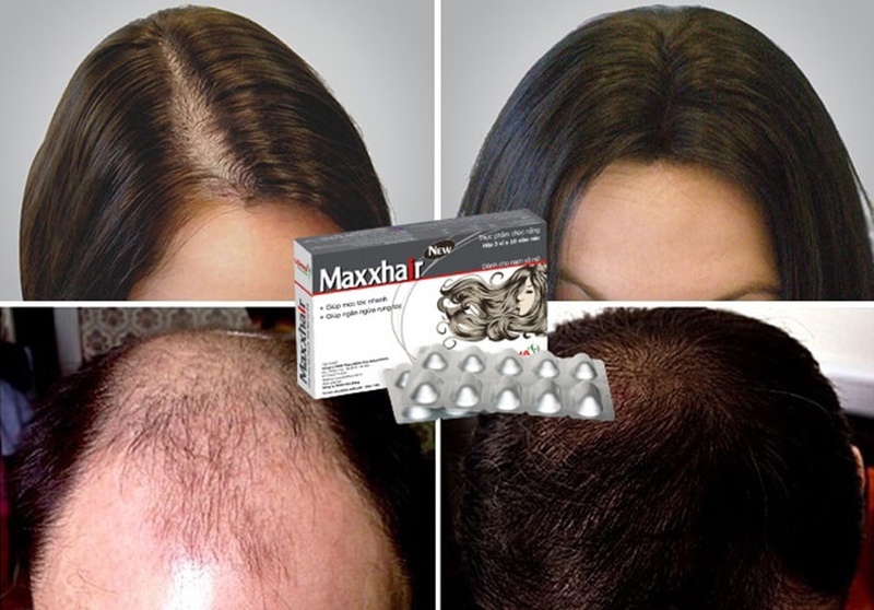Review viên uống chống rụng tóc Maxxhair có tốt không 3