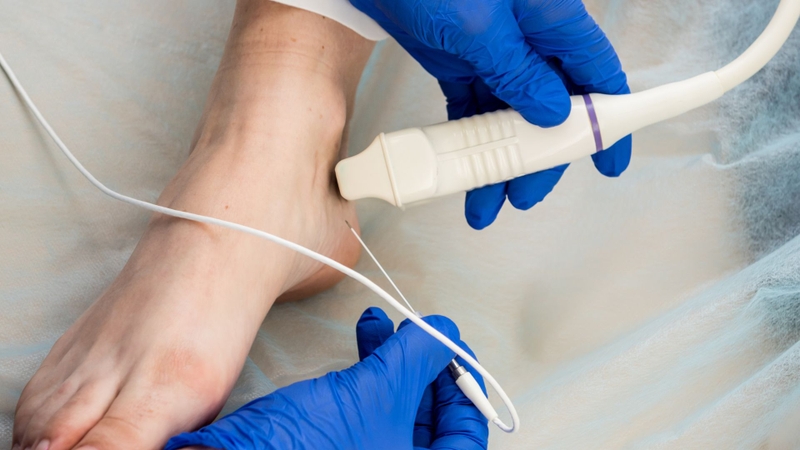 Kim RFA được đưa vào vị trí cần đốt dưới sự hỗ trợ của phương pháp hình ảnh học