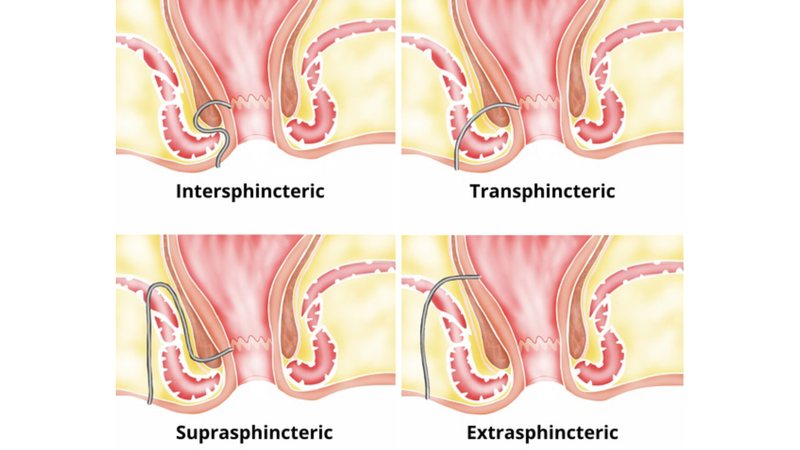 Rò hậu môn xuyên cơ thắt: Thông tin quan trọng cần biết 1