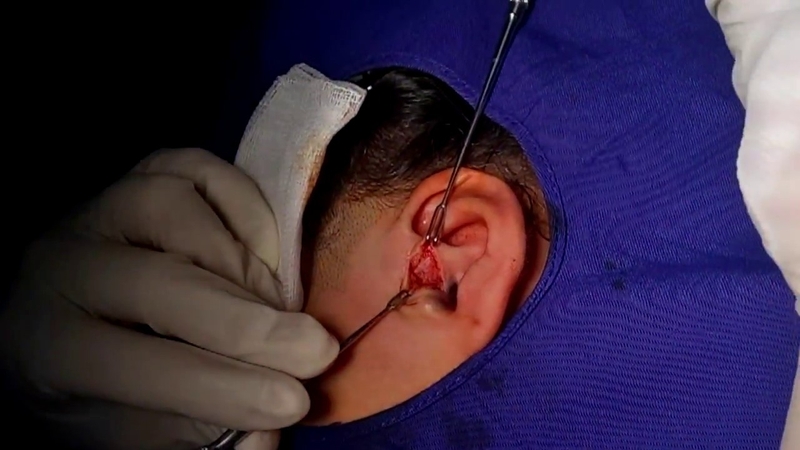 Rò luân nhĩ có di truyền không 3