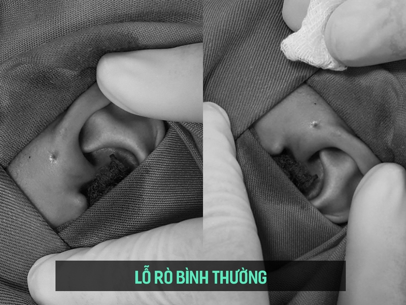 rò luân nhĩ có nguy hiểm không 1