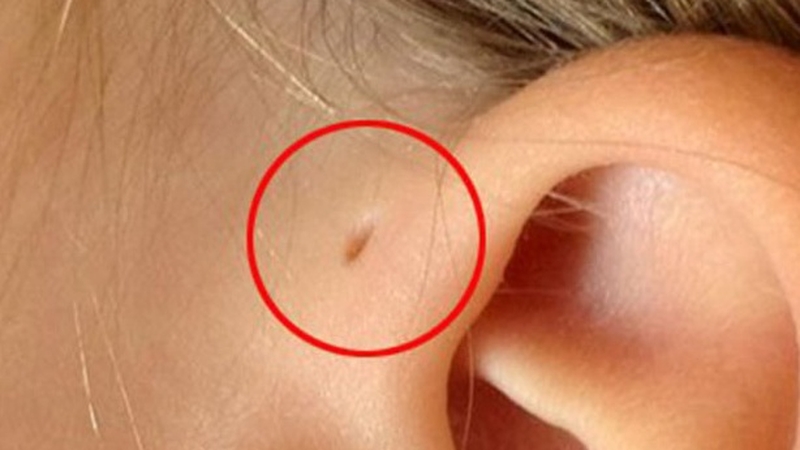 Rò luân nhĩ có nguy hiểm không? Nguyên nhân & dấu hiệu của bệnh là gì? 1