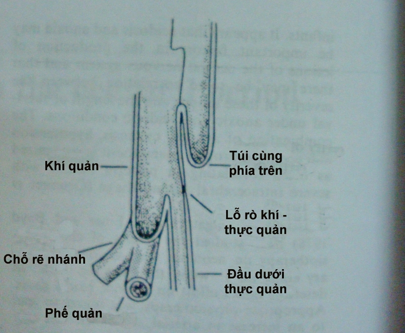 Rò thực quản và khí quản: Nguyên nhân, triệu chứng và phương pháp điều trị 1