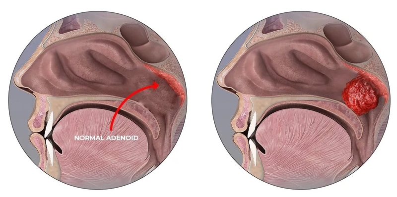 Rối loạn Adenoid là gì? Nguyên nhân và triệu chứng của rối loạn Adenoid 2