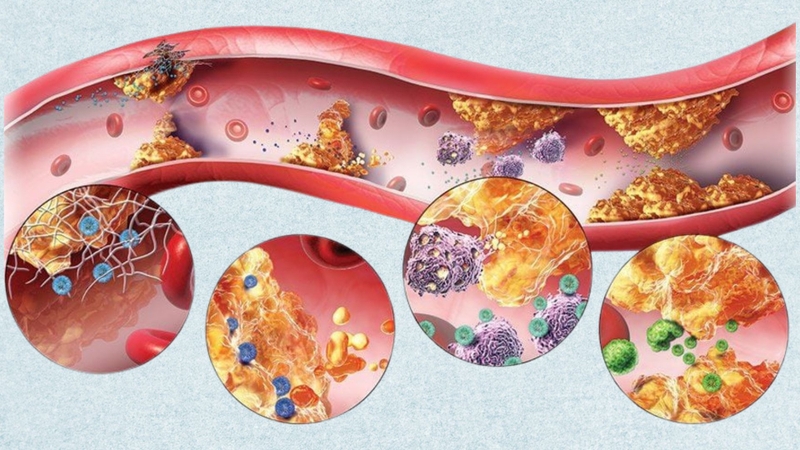 Rối loạn chuyển hóa lipid là gì?