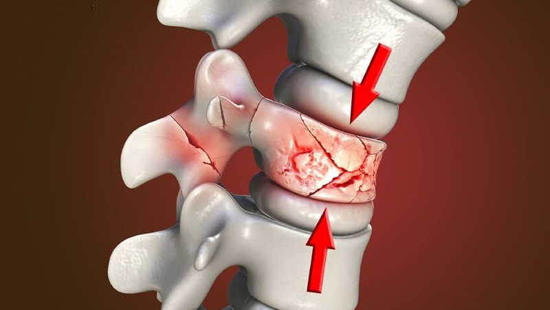 Rối loạn cong cột sống là gì? Có chữa được không? 4
