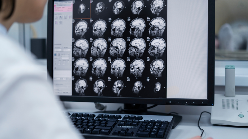 Chẩn đoán hình ảnh giúp xác định chính xác mức độ tổn thương thần kinh